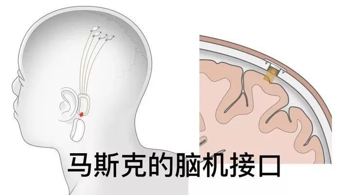 马斯克要在你脑袋上钻窟窿眼了