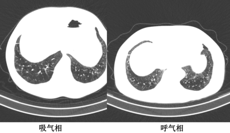 曾庆思教授：慢性阻塞性肺疾病的影像表现及研究进展