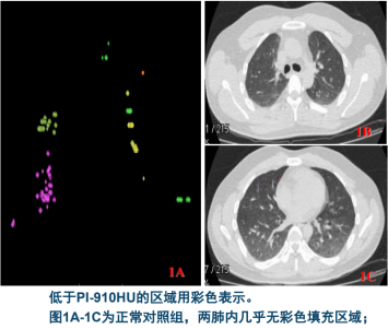 曾庆思教授：慢性阻塞性肺疾病的影像表现及研究进展