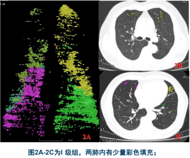 曾庆思教授：慢性阻塞性肺疾病的影像表现及研究进展