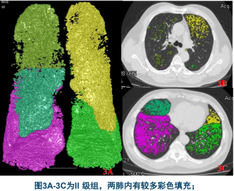 曾庆思教授：慢性阻塞性肺疾病的影像表现及研究进展