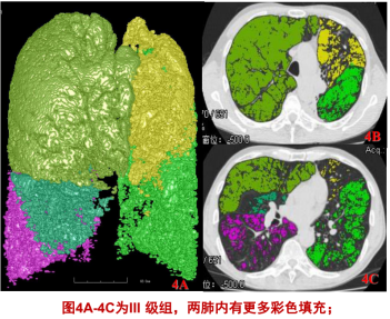 曾庆思教授：慢性阻塞性肺疾病的影像表现及研究进展