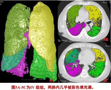 曾庆思教授：慢性阻塞性肺疾病的影像表现及研究进展