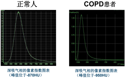 曾庆思教授：慢性阻塞性肺疾病的影像表现及研究进展