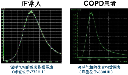 曾庆思教授：慢性阻塞性肺疾病的影像表现及研究进展