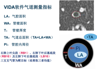 曾庆思教授：慢性阻塞性肺疾病的影像表现及研究进展