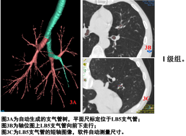 曾庆思教授：慢性阻塞性肺疾病的影像表现及研究进展