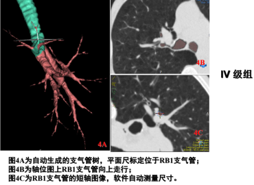 曾庆思教授：慢性阻塞性肺疾病的影像表现及研究进展