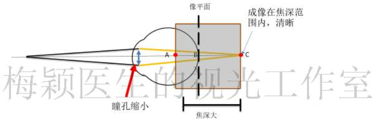 老视治疗技术（下篇）