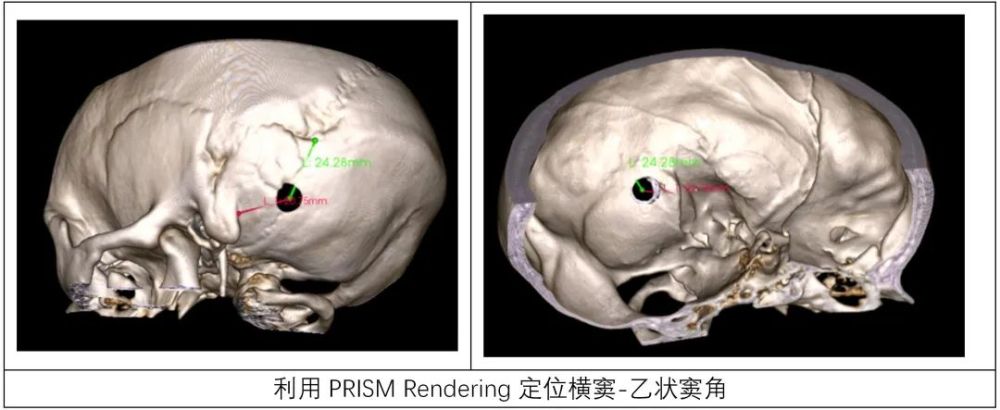 3DSlicer软件的渲染功能在乙状窦后入路定位横窦-乙状窦角的应用