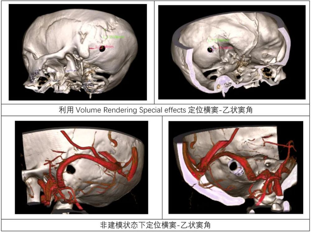 3DSlicer软件的渲染功能在乙状窦后入路定位横窦-乙状窦角的应用