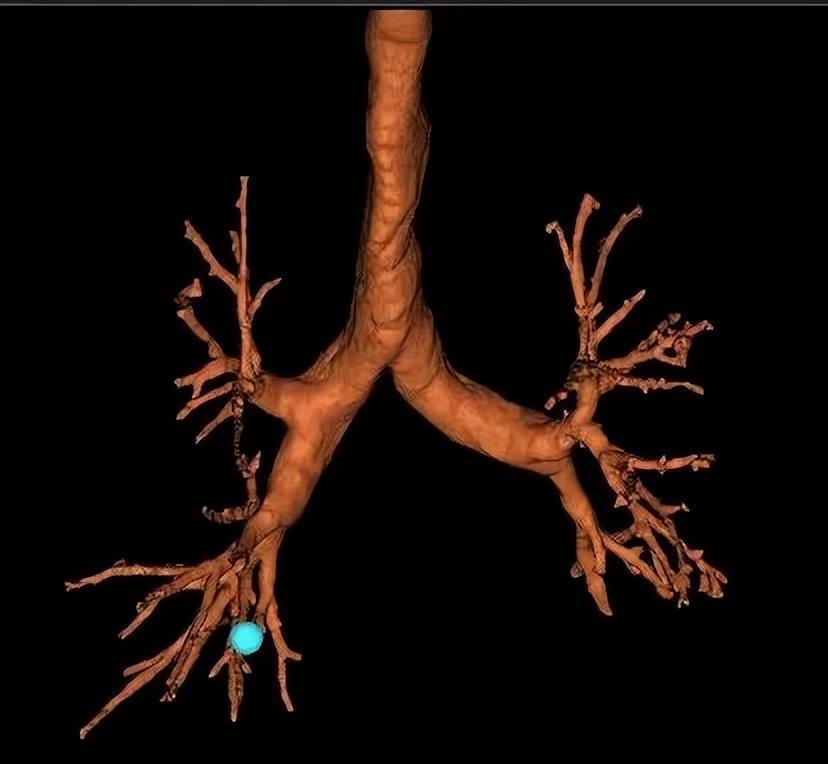 肺结节存疑？很简单，做支气管检查时来个“定位导航”