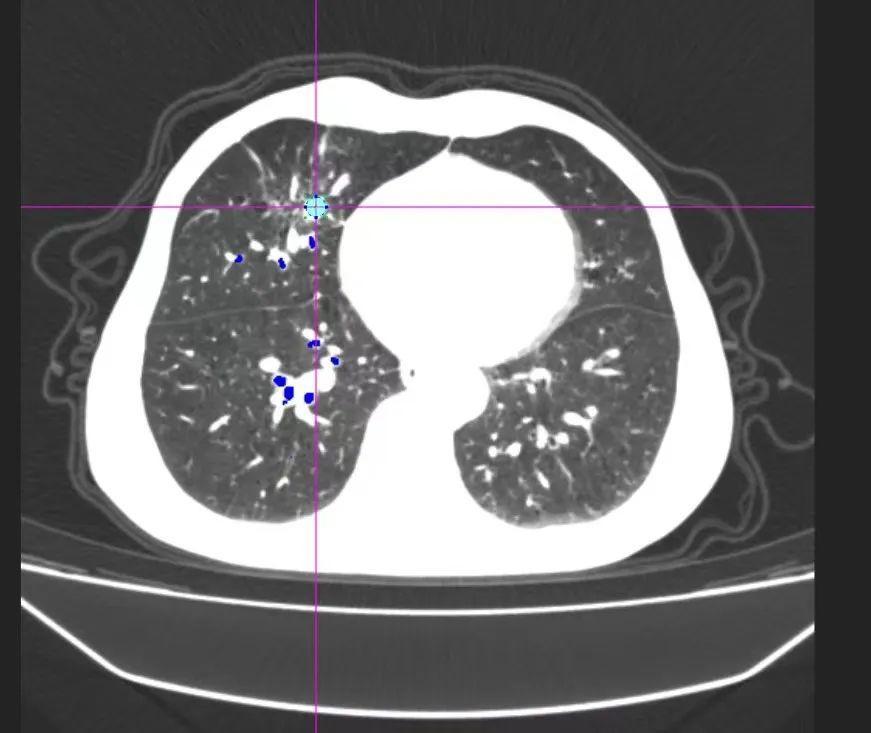 肺结节存疑？很简单，做支气管检查时来个“定位导航”