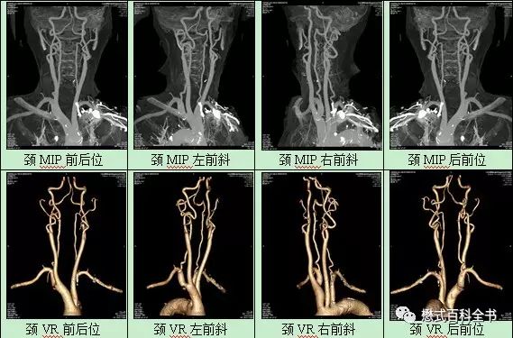 【转】CTA图像