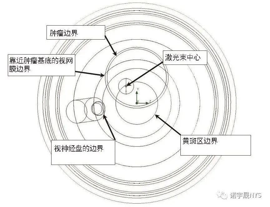 眼内肿瘤经瞳孔温热疗法的数值仿真